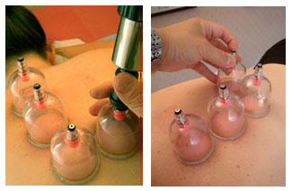 Cupping